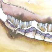 Diastema  (Diastase)